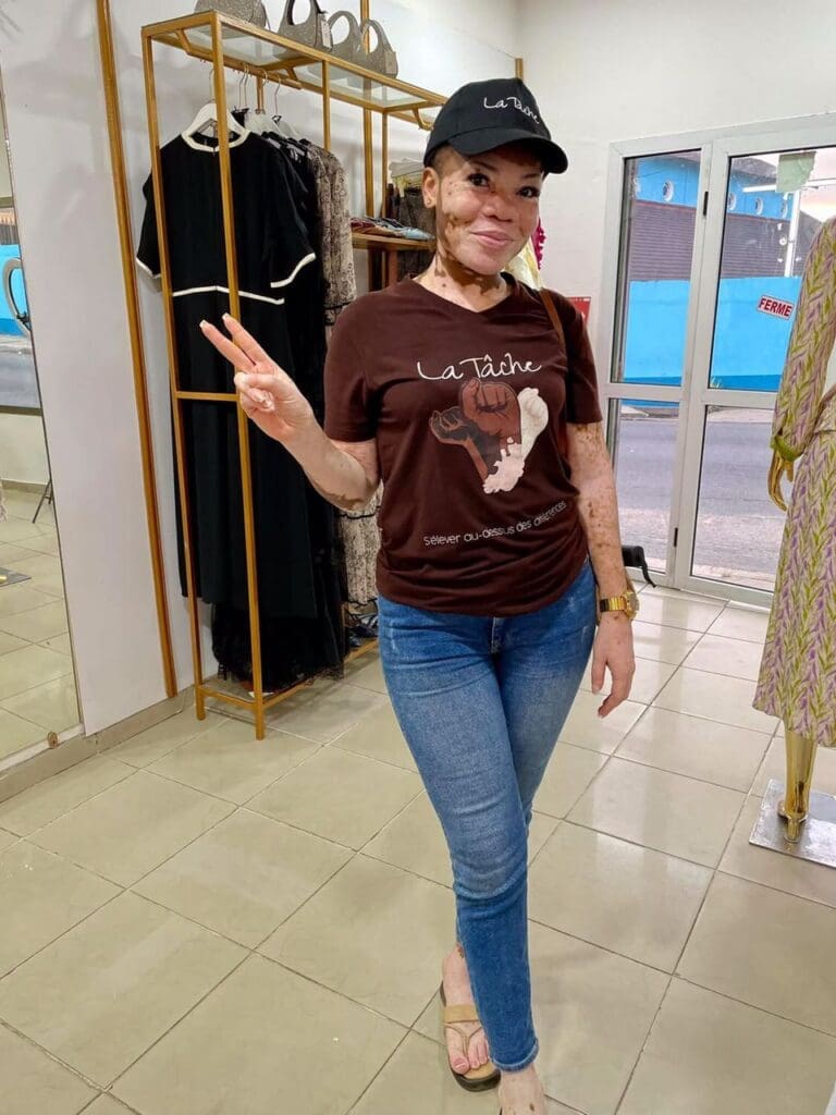 Ornella Tonda : du vitiligo à l’engagement pour les enfants